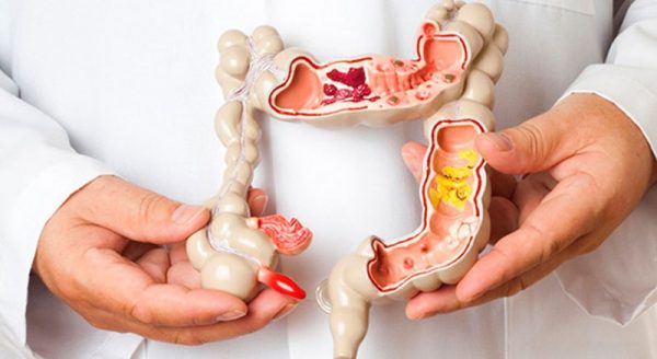 Estudo mostra que tratamento para c&acirc;ncer colorretal metast&aacute;tico com muta&ccedil;&atilde;o  BRAF resulta em sobrevida global m&eacute;dia de 15,3 meses | Newslab