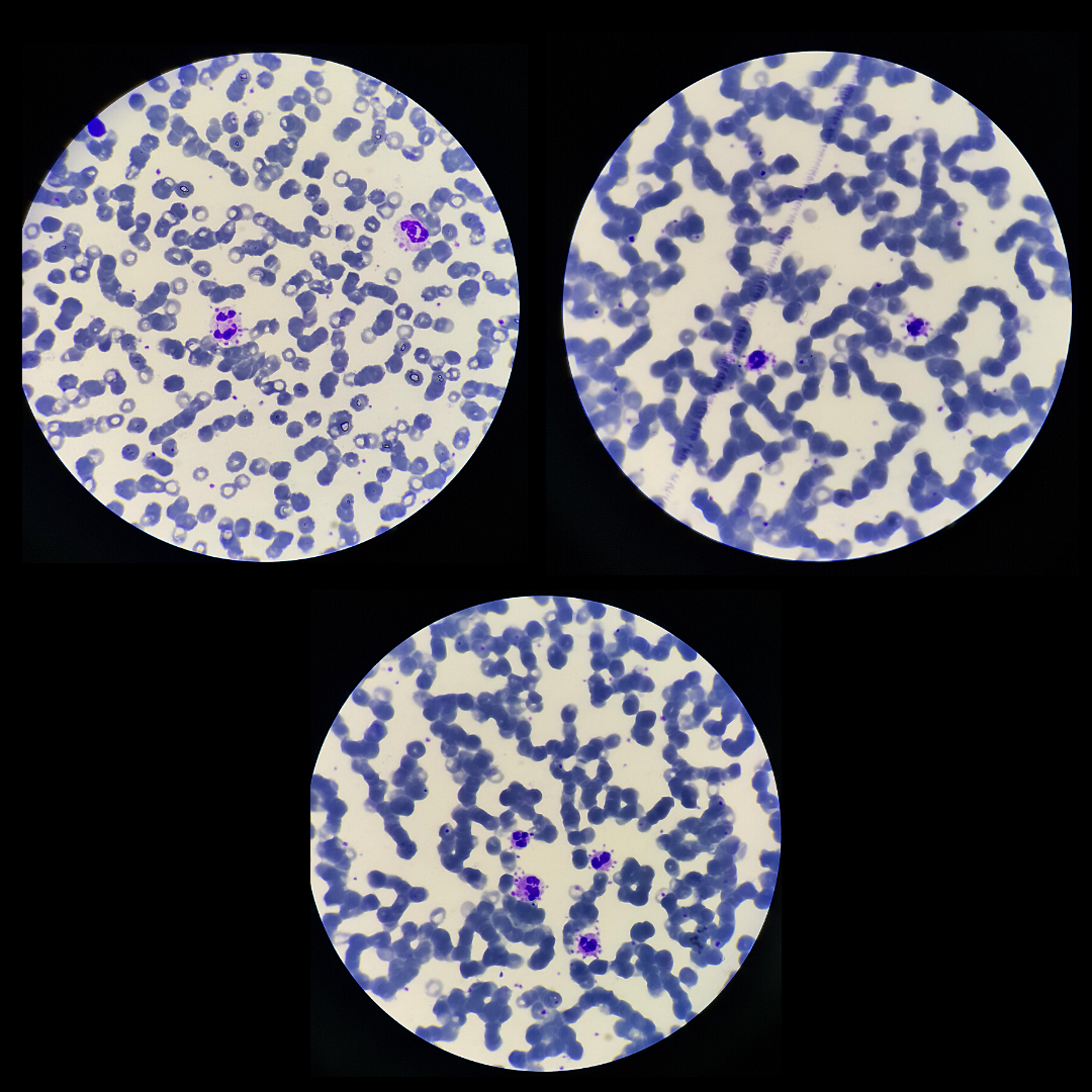 IMAGENS EM HEMATOLOGIA 🩸📸 | Satelitismo Plaquetário | Newslab