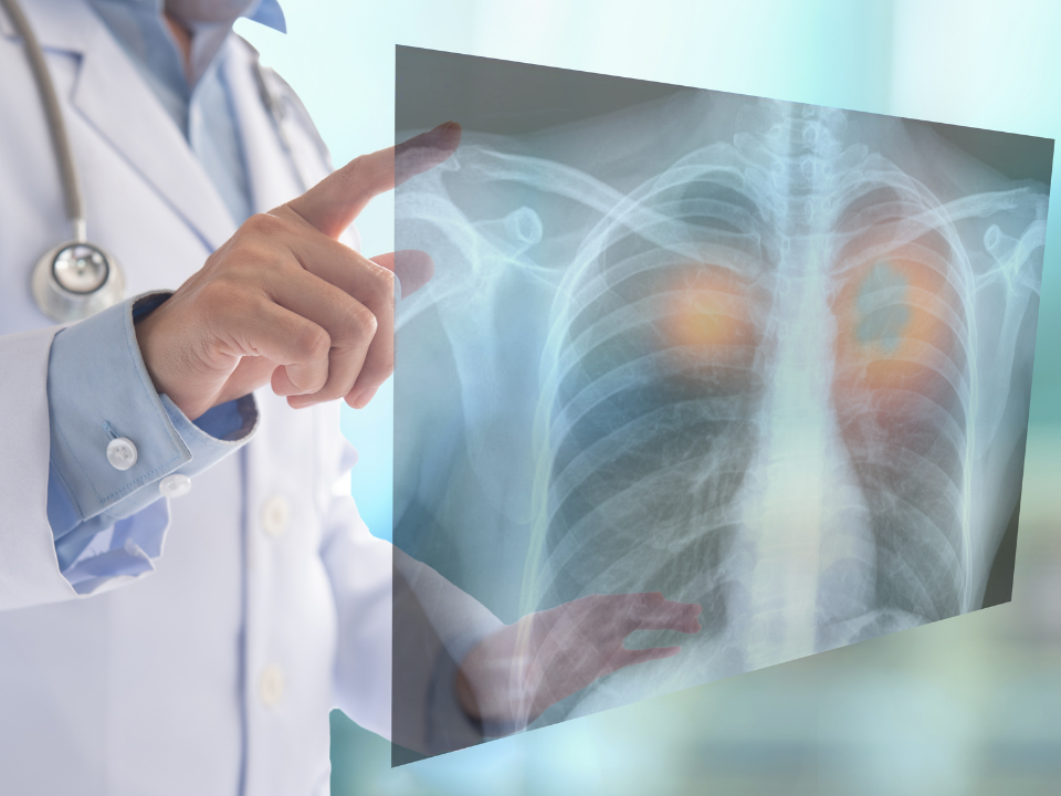 Câncer de pulmão: estudos comprovam que chegada tardia do paciente ao sistema de saúde e demora do acesso ao tratamento reduz pela metade as chances de cura da doença