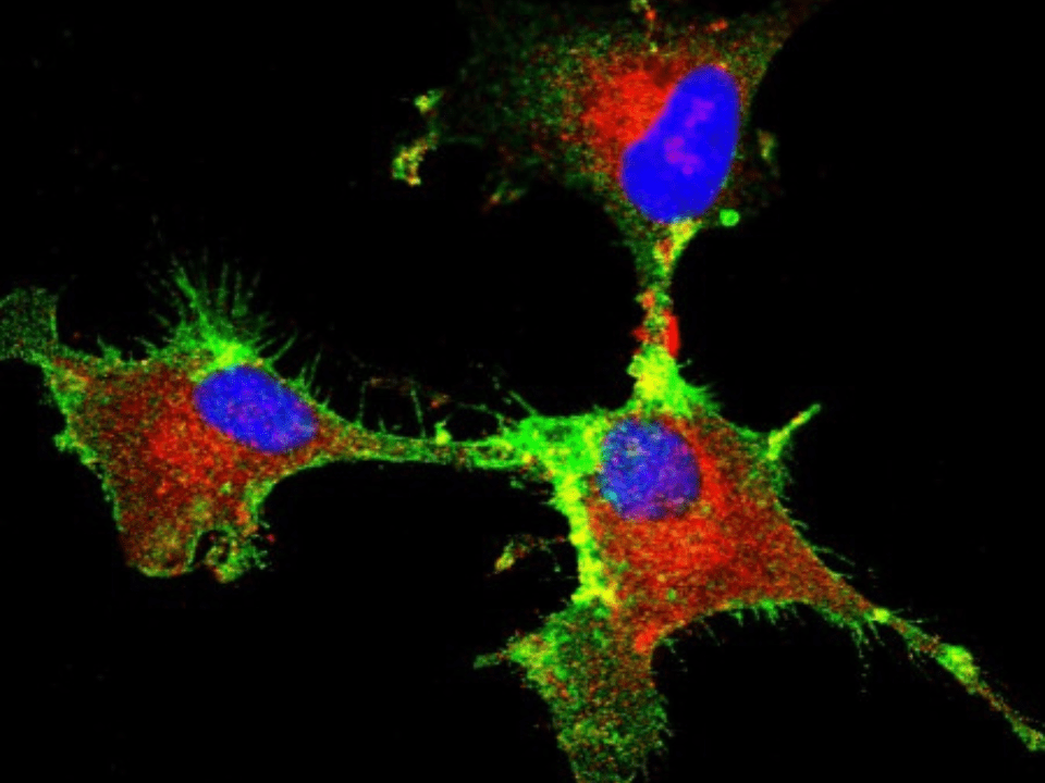 Estudo revela proteína-chave para a progressão do glioblastoma, um tipo de tumor cerebral