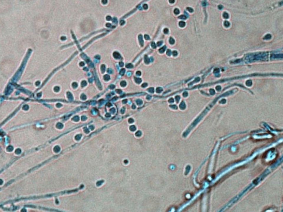 Primeiro caso de fungo resistente que causa micose extensa foi identificado no Brasil