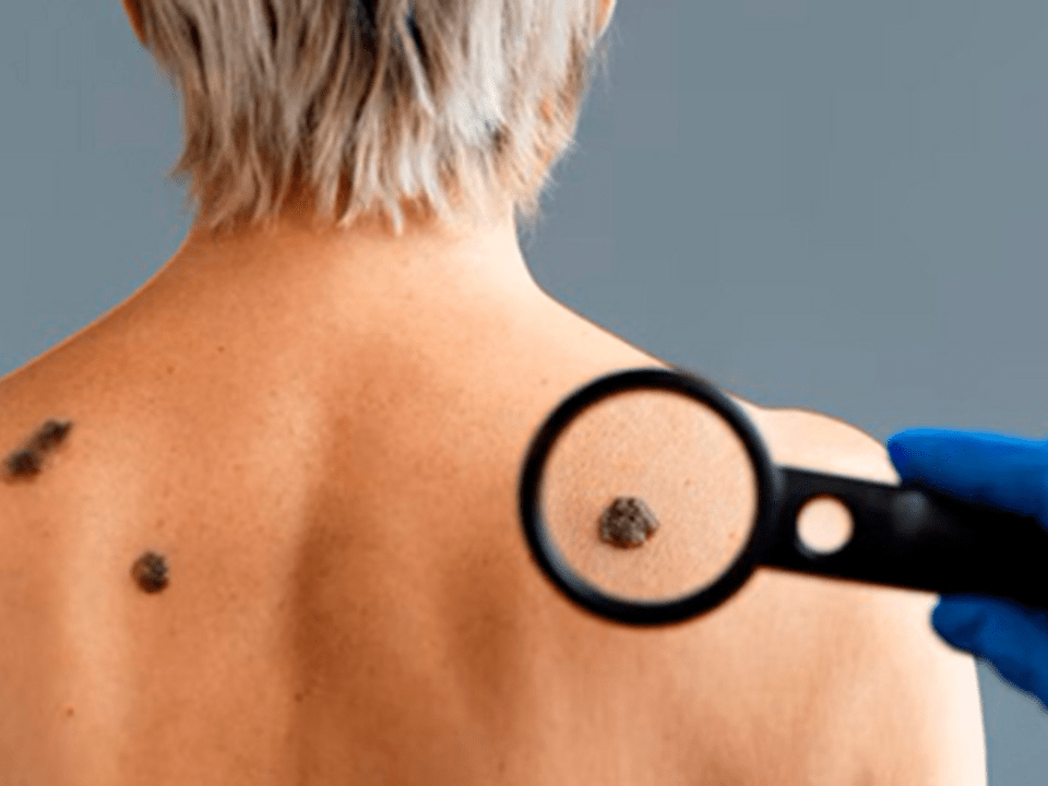 Associação entre bactérias e luz pode aumentar reação do corpo contra câncer de pele agressivo