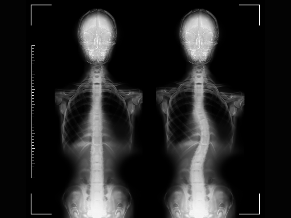 Cirurgia de coluna: implantes inteligentes ampliam eficácia; entenda