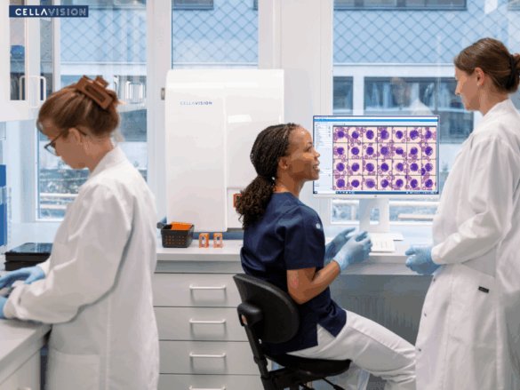 Cellavision Criança de 2 anos com células grandes semelhantes a blastos