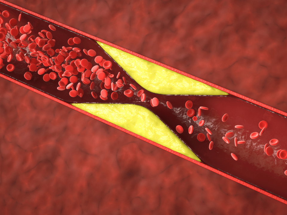 Dose única de medicamento reduz colesterol em até 69%, diz estudo inicial