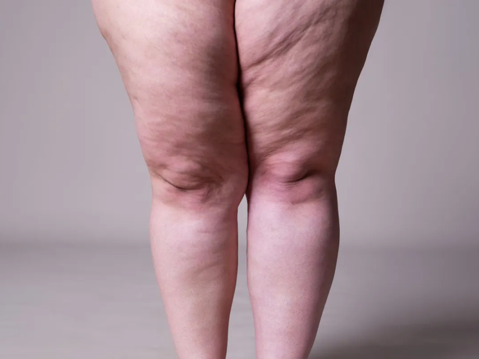 Lipedema e linfedema: entenda as diferenças e como tratar