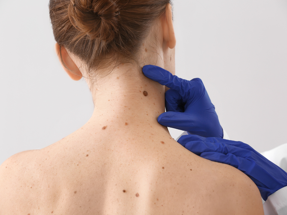Identificados genes que podem prever resposta de pacientes com melanoma à imunoterapia