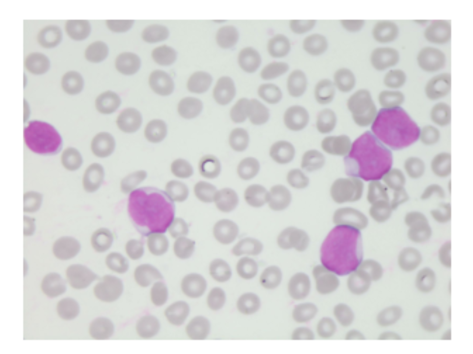 como identificar blastos