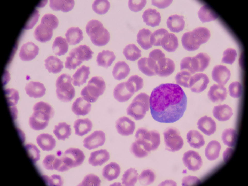 Linfócitos anormais ou anômalos