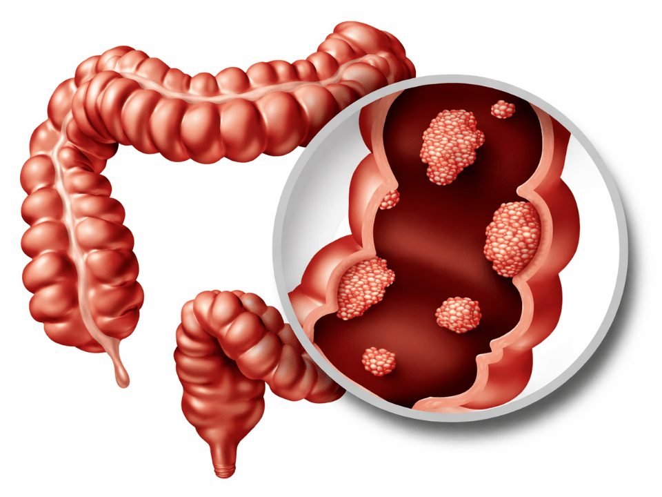 Ilustração médica do cólon humano com ampliação de pólipos associados ao câncer colorretal, utilizada para contextualizar exames de rastreamento e diagnóstico.