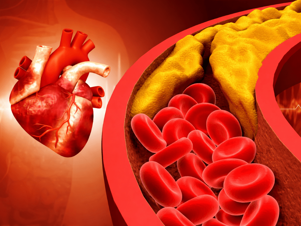 Ilustração médica do coração humano e de artéria com placa aterosclerótica, representando dislipidemias e risco cardiovascular abordados na Diretriz Brasileira de Dislipidemias 2025.