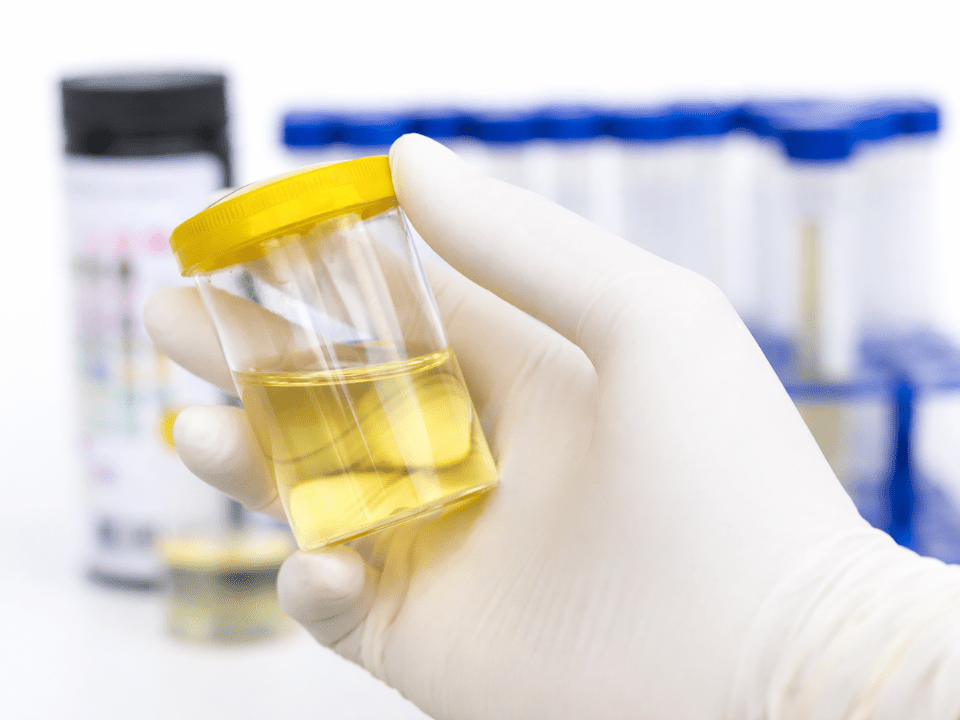 Amostra de urina em frasco coletor sendo analisada em ambiente laboratorial para testes toxicológicos em serviços de emergência.