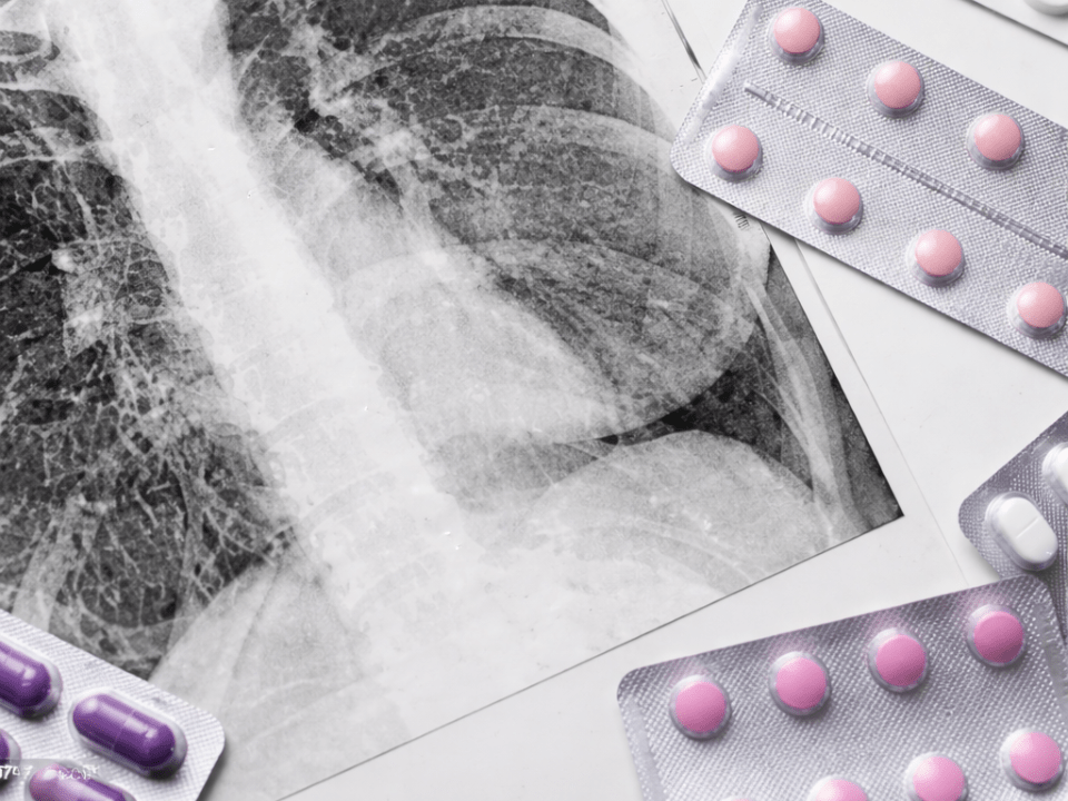Radiografia de tórax com blisters de medicamentos antimicrobianos, representando diagnóstico da tuberculose e gestão do uso de antimicrobianos.