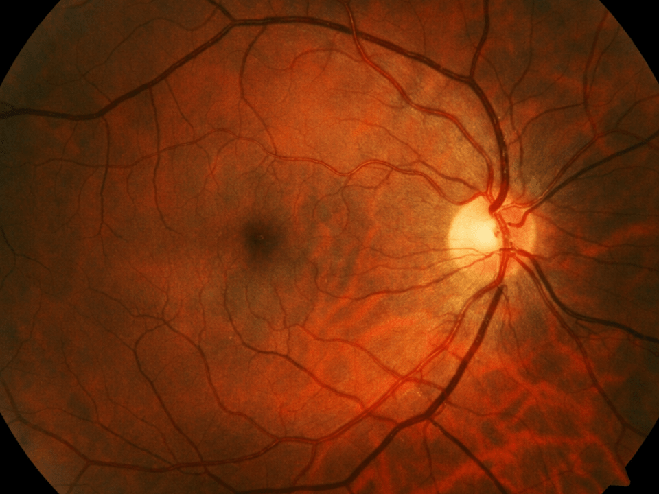 Imagem de fundo de olho mostrando a retina com vasos sanguíneos e disco óptico visíveis, utilizada na avaliação de doenças oculares como a retinose pigmentar.