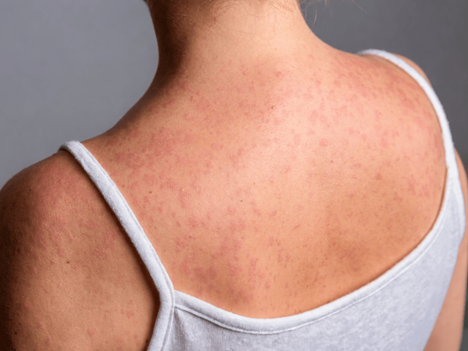 Pessoa com erupção cutânea avermelhada nas costas, manifestação típica do sarampo, imagem ilustrativa sobre aumento de casos da doença nas Américas.