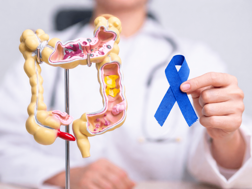 Profissional de saúde segurando laço azul ao lado de modelo anatômico do cólon com representação interna de lesões, simbolizando conscientização e diagnóstico do câncer colorretal.