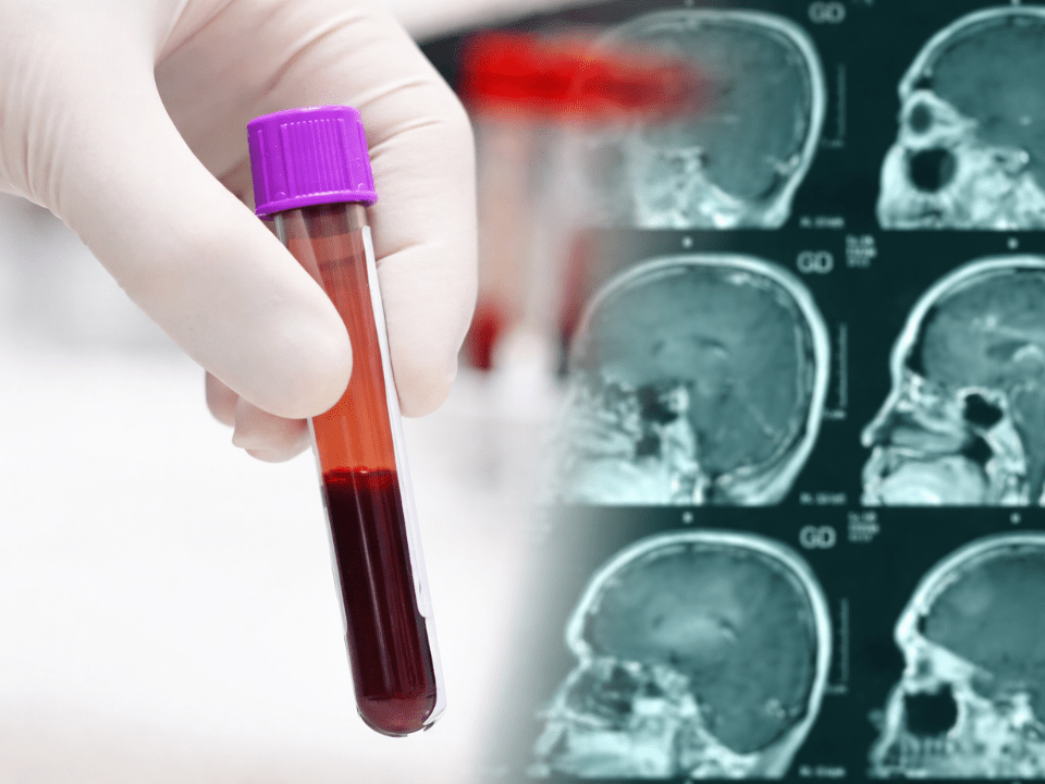 Tubo de ensaio com amostra de sangue sendo segurado por mão com luva em primeiro plano, com imagens de ressonância magnética do cérebro ao fundo, ilustrando teste sanguíneo para demência e biomarcadores neurológicos.