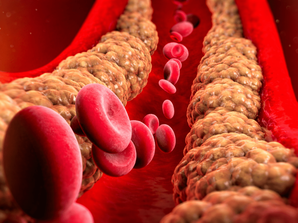 Ilustração biomédica de artéria com acúmulo de placas de gordura e fluxo de hemácias, representando risco cardiovascular nas diretrizes de colesterol 2026.