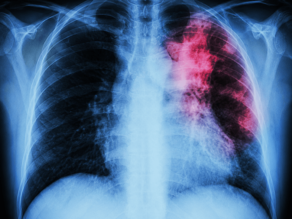 Radiografia de tórax com destaque para lesão pulmonar compatível com tuberculose, ilustrando avanços em automação no diagnóstico da tuberculose latente com suporte de inteligência artificial e testes IGRA em medicina diagnóstica.