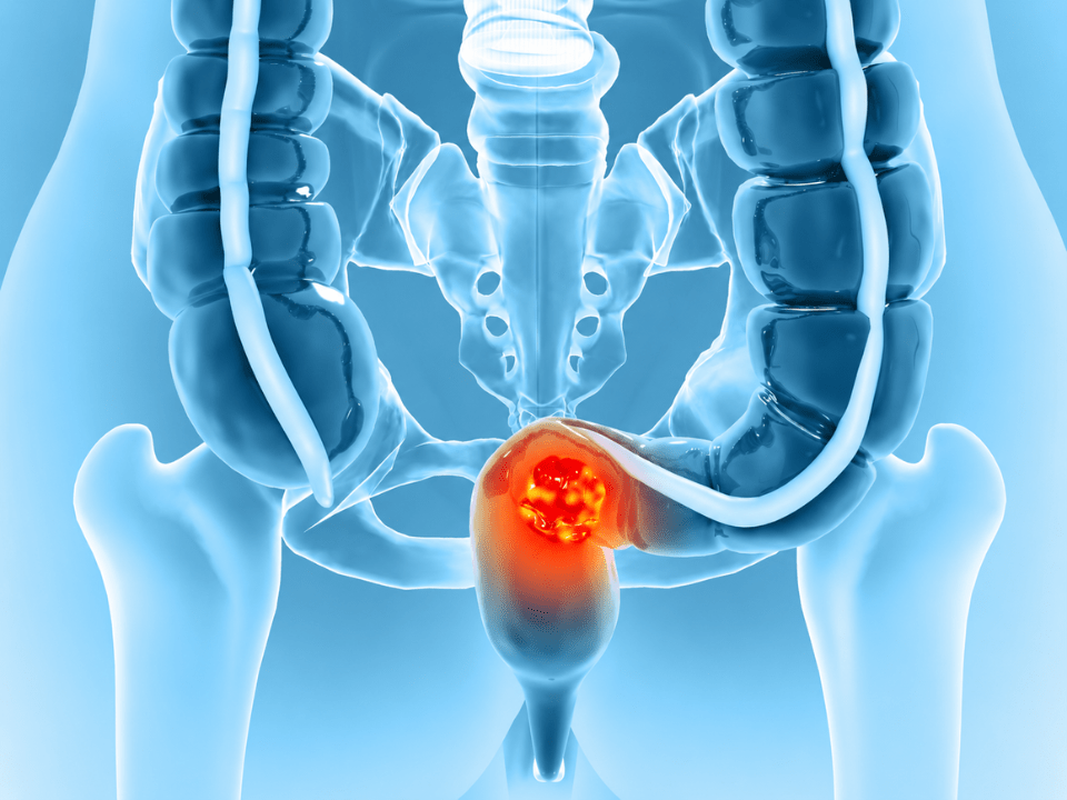 Ilustração médica em 3D do intestino grosso e reto com destaque para lesão tumoral, representando o rastreamento do câncer colorretal por teste imunológico fecal no SUS.