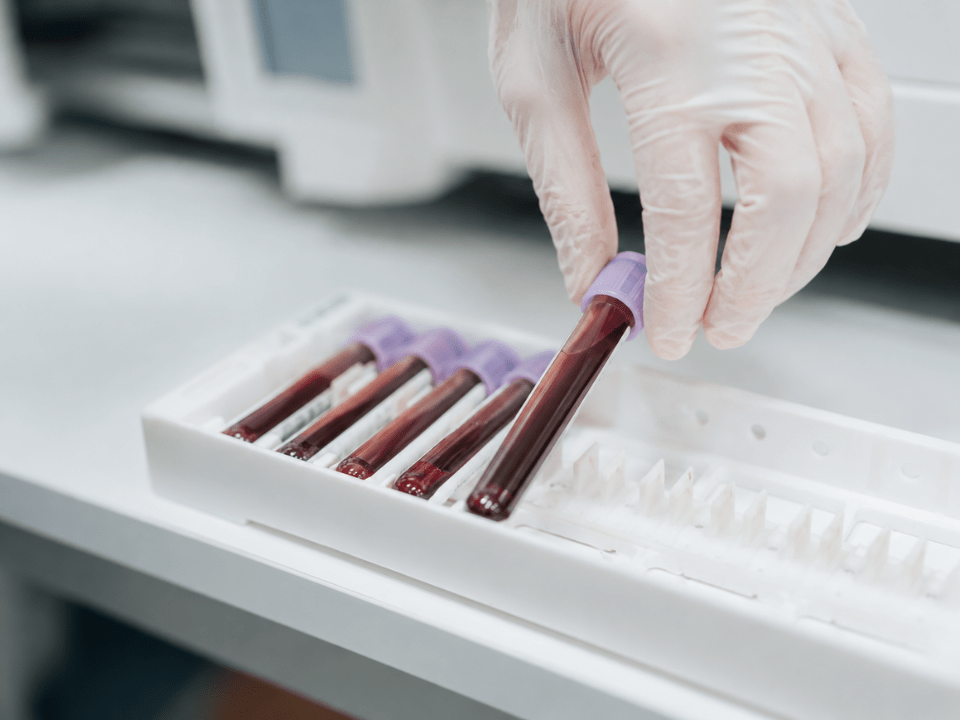 Teste multicâncer realizado a partir de amostras de sangue em laboratório de diagnóstico molecular, destacando a detecção precoce de câncer por análise de DNA tumoral circulante e biomarcadores avançados.