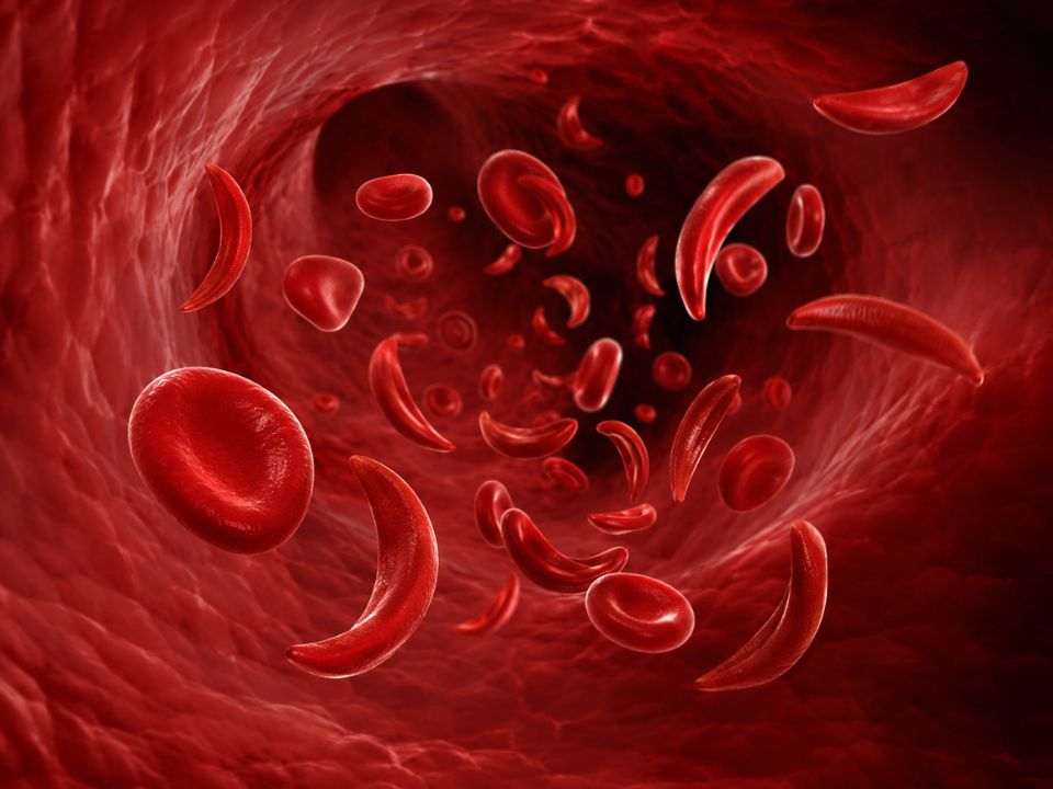 Ilustração médica da doença falciforme com hemácias falciformes características em formato de foice circulando na corrente sanguínea. A imagem destaca alterações celulares associadas à condição genética e reforça a relevância do diagnóstico precoce da doença falciforme, da triagem neonatal e do acompanhamento laboratorial para reduzir complicações clínicas.