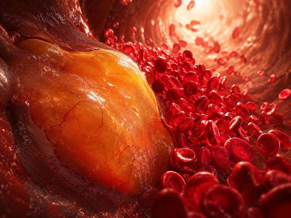 Imagem científica representando fluxo sanguíneo, hemácias e acúmulo lipídico em vaso, em contexto visual sobre gorduras e diabetes tipo 2, metabolismo lipídico, resistência à insulina e risco cardiometabólico.
