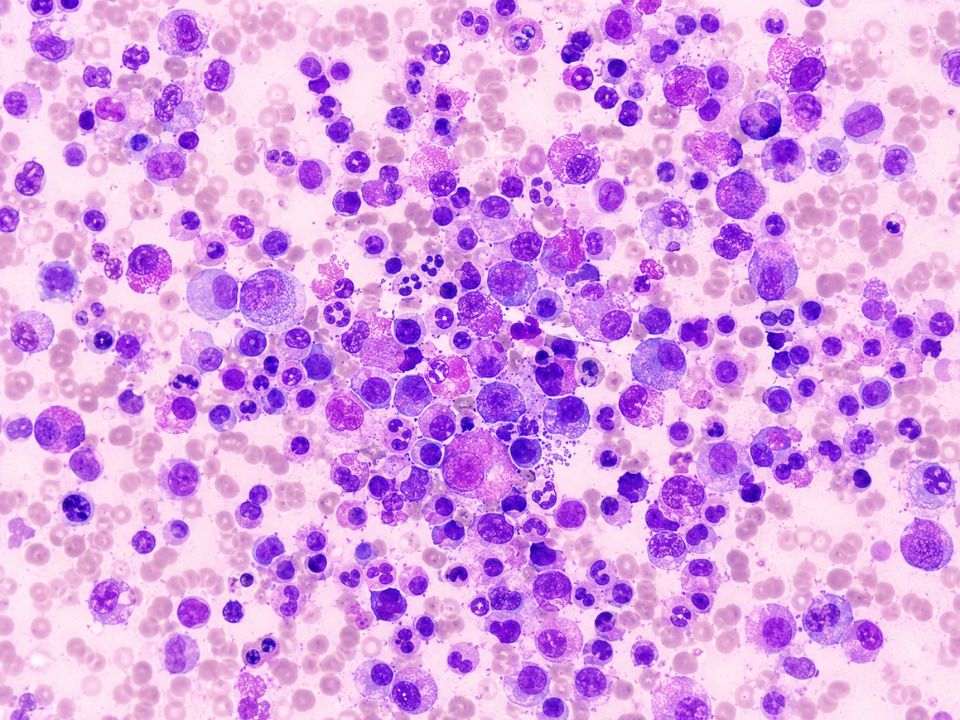 Sequenciamento genômico identifica sinais precoces da progressão das neoplasias mieloproliferativas antes de alterações clínicas.