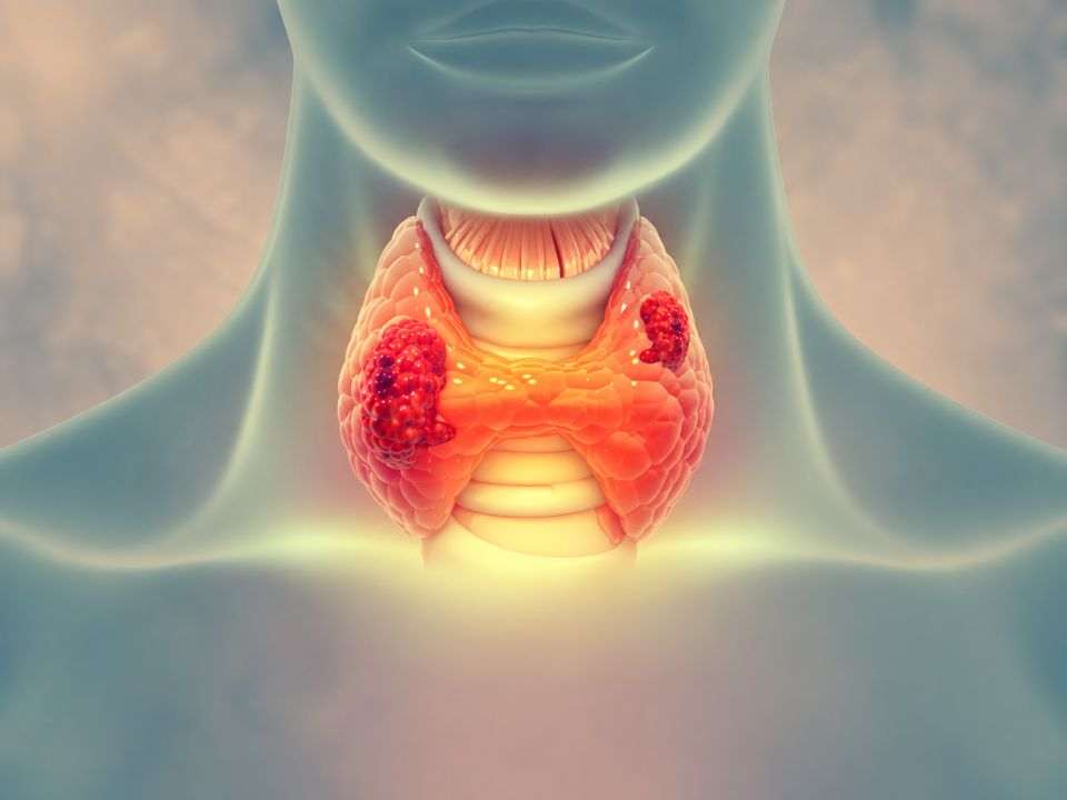 Categorias citológicas mais elevadas foram associadas a características anatomopatológicas adversas em pacientes com câncer de tireoide.