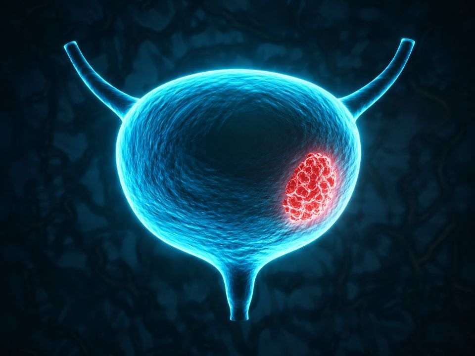 Teste genômico urinário alcançou sensibilidade de 92,2% e identificou todos os casos de câncer de bexiga músculo invasivo na coorte estudada.