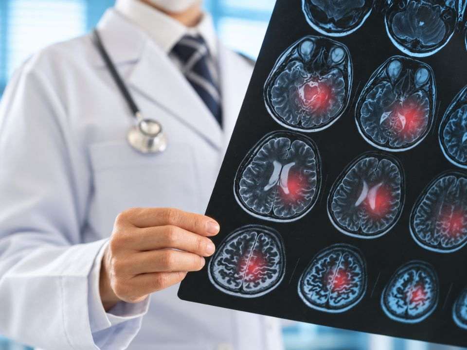 AVC em adultos jovens: imagem ilustrativa sobre saúde cerebrovascular e diagnóstico.