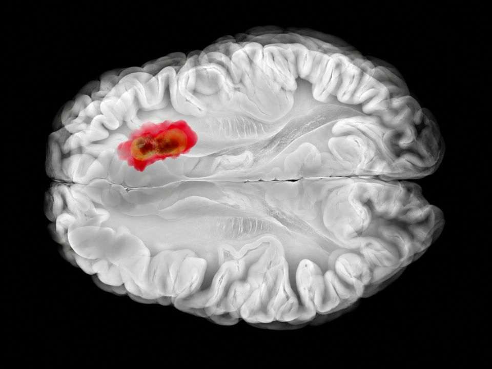 Pesquisadores da Universidade Purdue e da Mayo Clinic desenvolveram uma abordagem de espectrometria de massas que analisa tecido cerebral em aproximadamente três minutos.